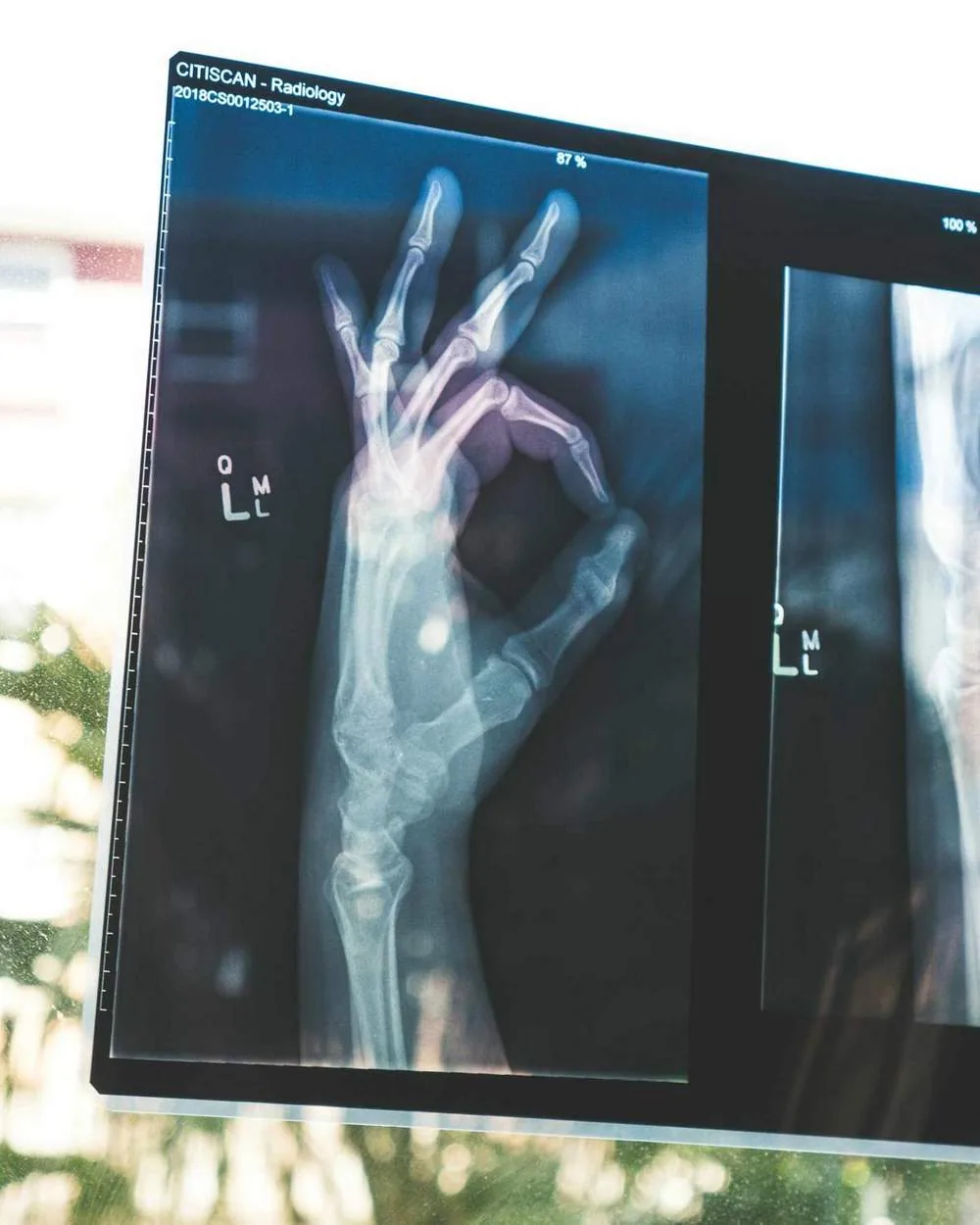 Murray chiropractor treating auto accident injury patient